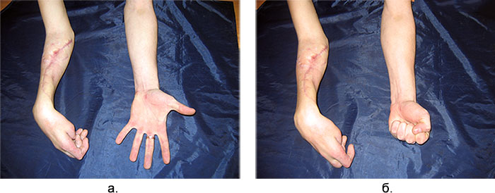 Рис 1а. Ішемічна контрактура правої кисті відсутність активного розгинання пальці. б. той же хворий відсутність активного згинання кисті.