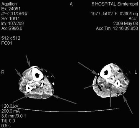 Рис. 5. Компьютерна томографія гомілок при МГІС тяжкого ступеня (стрілками позначені множинні некрози, що формуються).