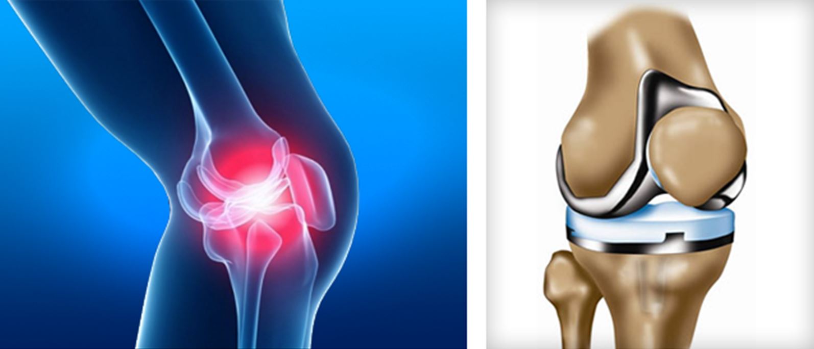 Восстановление сустава без операции. Эндопротез коленного сустава. ТЭП эндопротезирование коленного сустава. Остеоартроз травматология эндопротезирование.