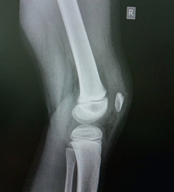 Рентгенографія: Забій колінного суглоба. Пошкодження надколінка.
