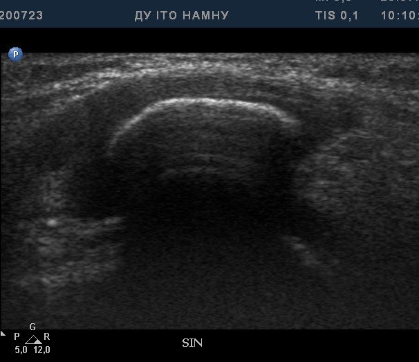 Рентгенографія: Рис. 4 – Надколінок зліва – здоровий (контрлатеральна сторона)