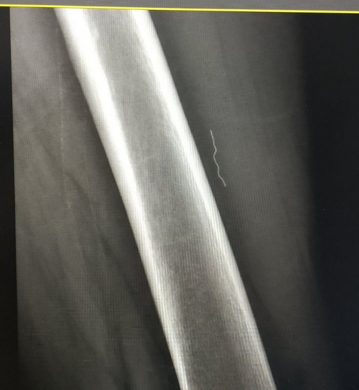 Рентгенографія: стороннє тіло в м'яких тканинах лівого стегна