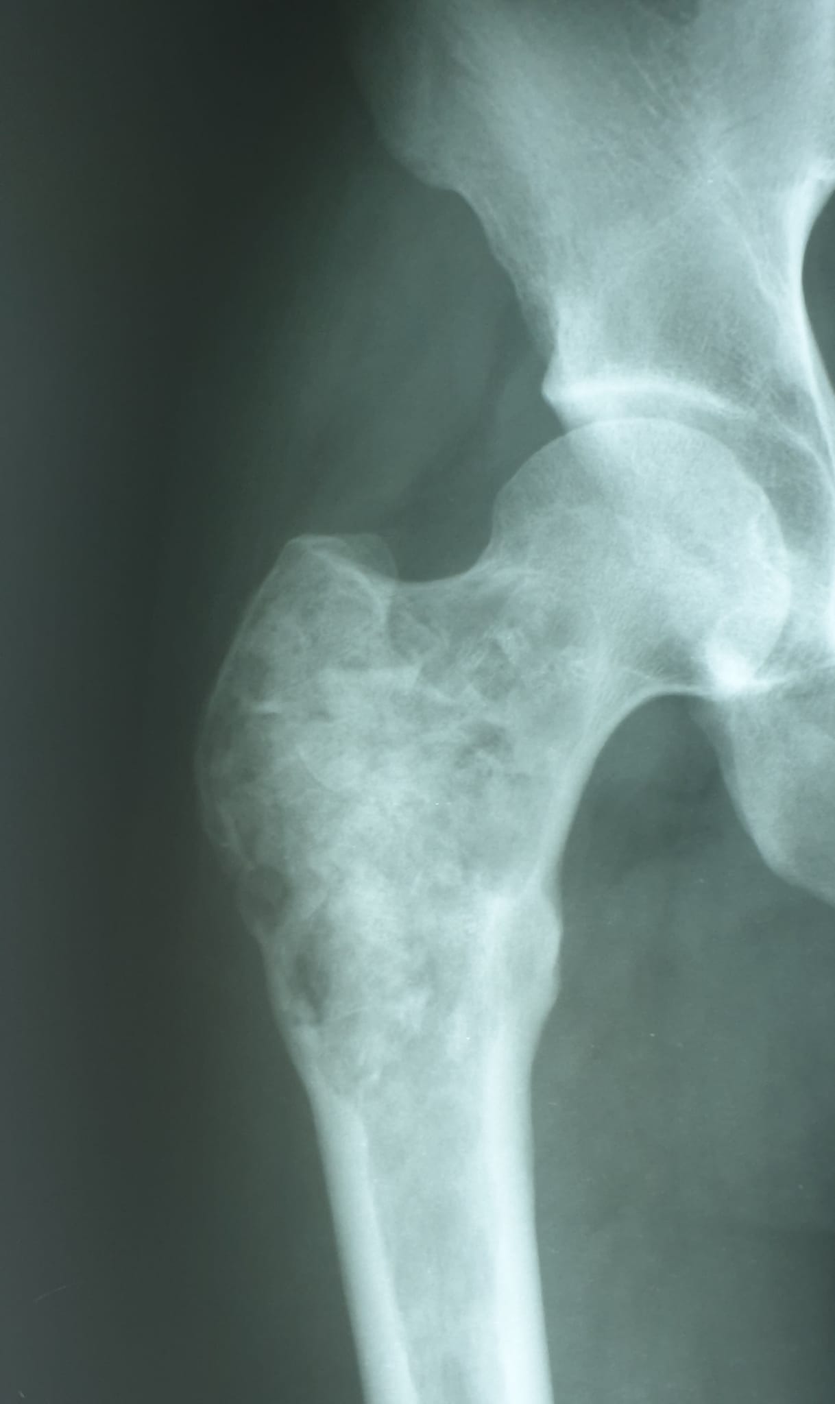 На рентгенограмі відзначається перебудова трансплантата.