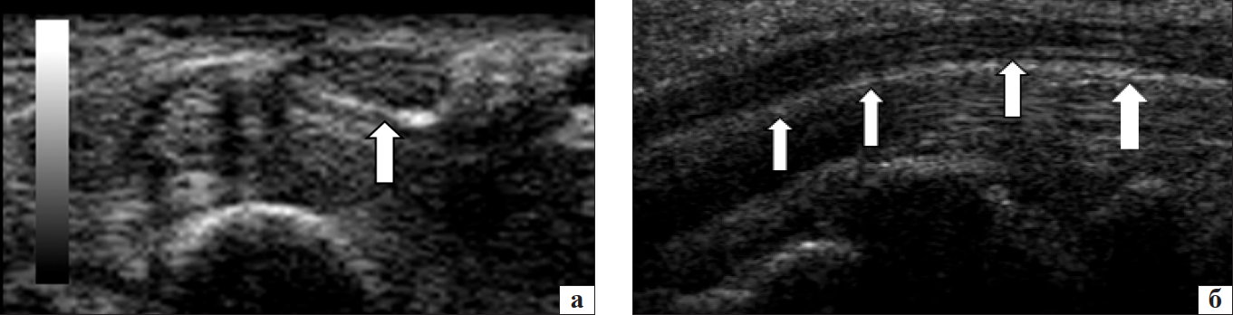Рис. 2. Сонографічне зображення серединного нерва в нормі  на рівні КК: поперечне (а) та поздовжнє (б) сканування