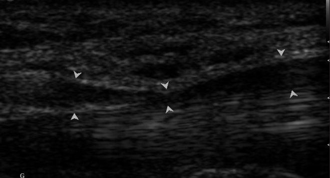 Рис. 3. Сонографічне зображення серединного нерва у хво- рого з КТС: компресія на рівні КК у вигляді симптому «піс- кового годинника»