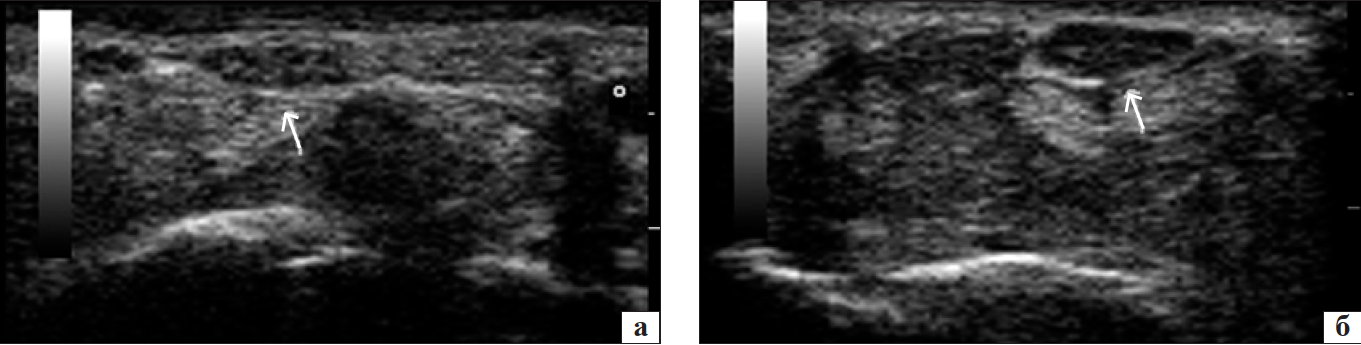 Рис. 4. Сонографічне зображення серединного нерва на рівні КК: нормальна (а) та знижена (б) ехогенність