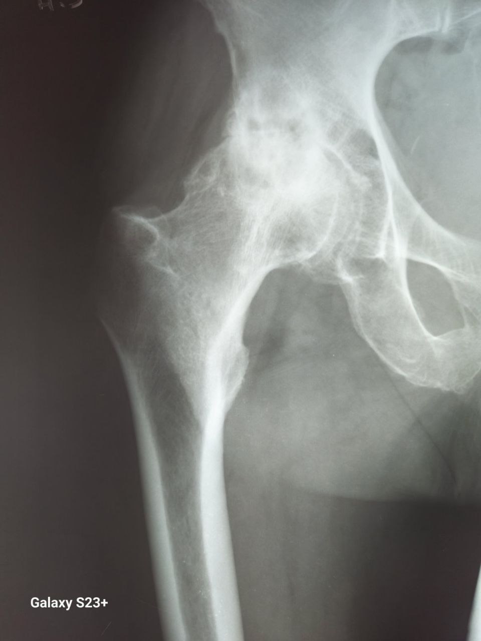 Фото рентгенограм до та після протезування правого кульшового суглоба протезом з короткою ніжкою