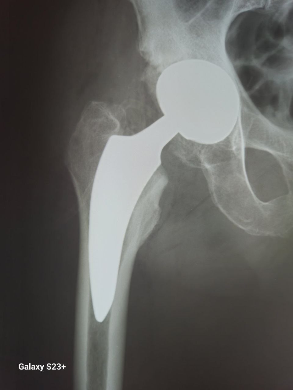 Фото рентгенограм до та після протезування правого кульшового суглоба протезом з короткою ніжкою