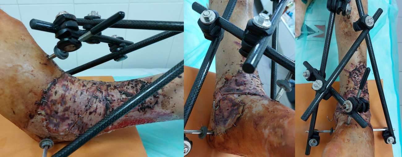 Зовнішній вигляд кінцівки через 8 днів після шкірної пластики та стабілізації гомілки в АЗФ