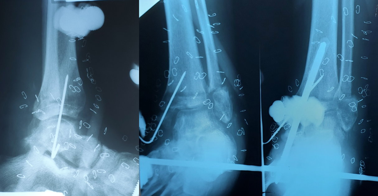 Фотовідбитки рентгенограм через 4 тижні після першого етапу оперативного лікування