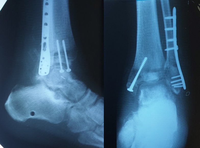 Рентгенконтроль після другого етапу хірургічного лікування – остеосинтезу латеральної кісточки пластиною та гвинтами, остеосинтезу медіальної кісточки 2-ма гвинтами (через 5 тижнів)