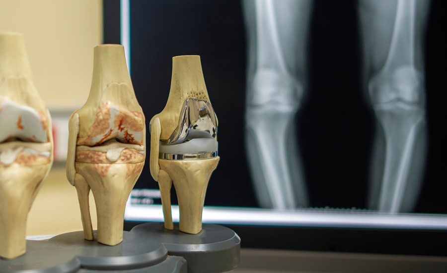 Остеоартроз (остеоартрит, гонартроз) колінного суглоба. Коли ставити діагноз? Коли та як починати лікувати?