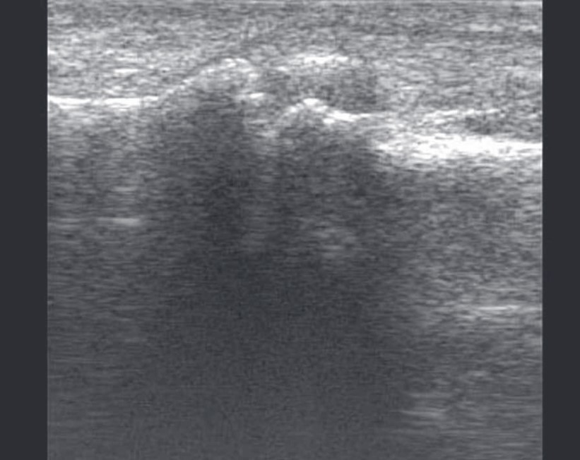 Рис. 10. Гонартроз, 4 стадія. Зовнішня поверхня колінного суглоба, сагітальна проекція; виражений пролапс меніска та дегенеративні зміни у ньому.