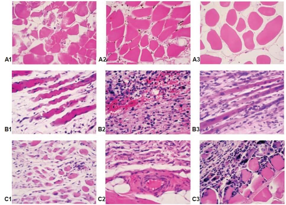 Fig. 8. rabbit SMT morphology after MII: interstitial edema and muscle fibers atrophy. Note: A – day 5 after MII; B – day 15 after MII; C – day 30 after MII; 1 – MII; 2 – MII + PRP; 3 – MII + CBMA. hematoxylin and eosin stain, original magnification ×400