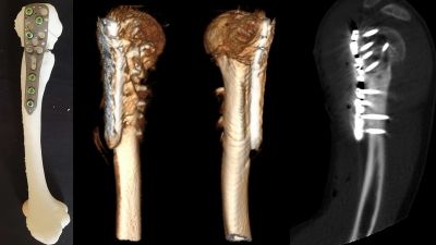 Corrective osteotomy for malunion of proximal humorous