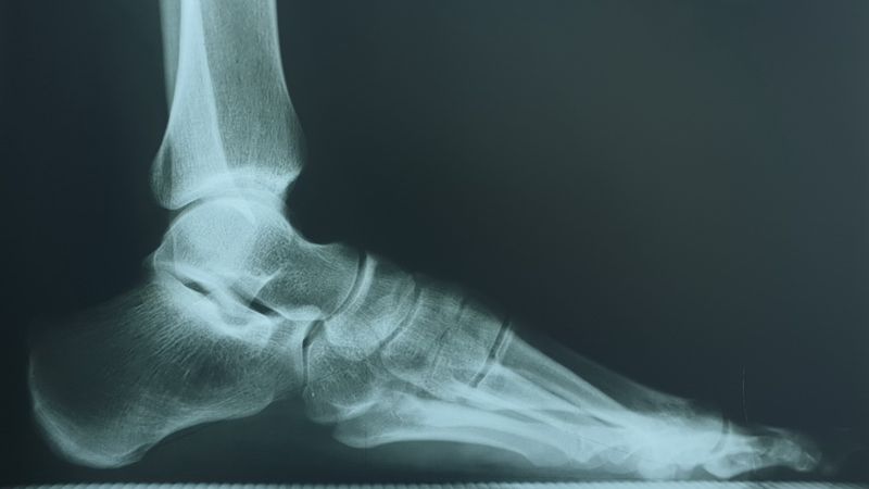 Нallux valgus