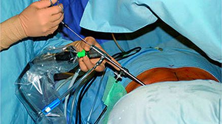 Endoscopic Micro-discectomy