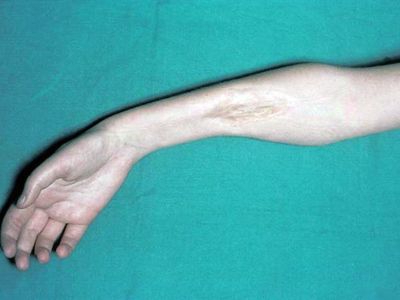 Diagnostic and Treatment of Ischemic Disorders of Limbs caused by Trauma