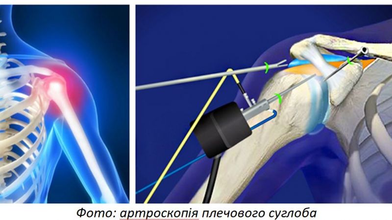 Arthroscopy of joints