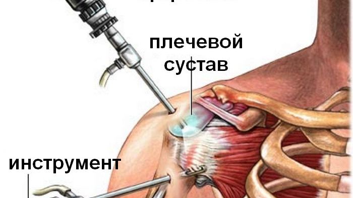 Shoulder-joint arthroscopy