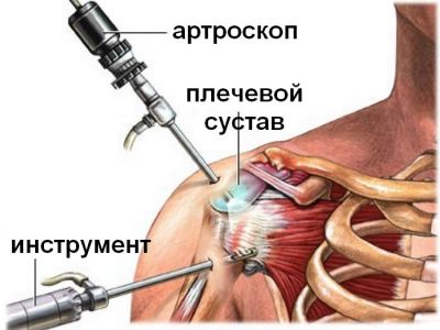Shoulder-joint arthroscopy
