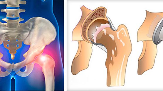 Rehabilitation after the hip replacement of the hip joint