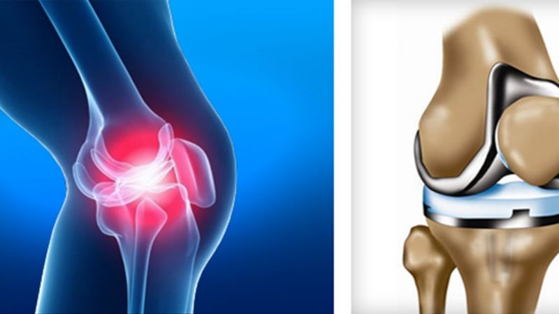 Knee joint replacement
