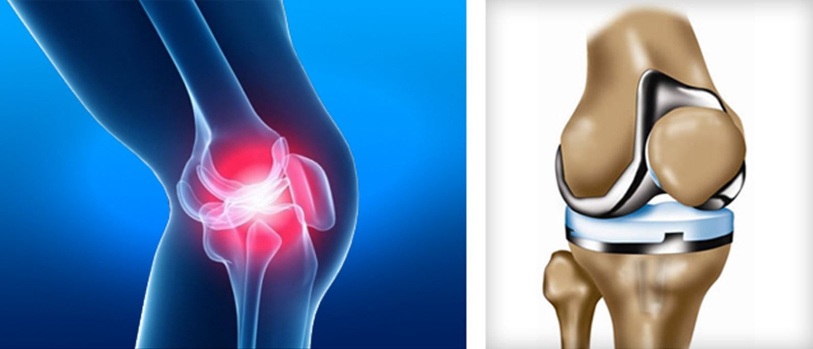 Tips to Speed Your Recovery after Knee Replacement Surgery
