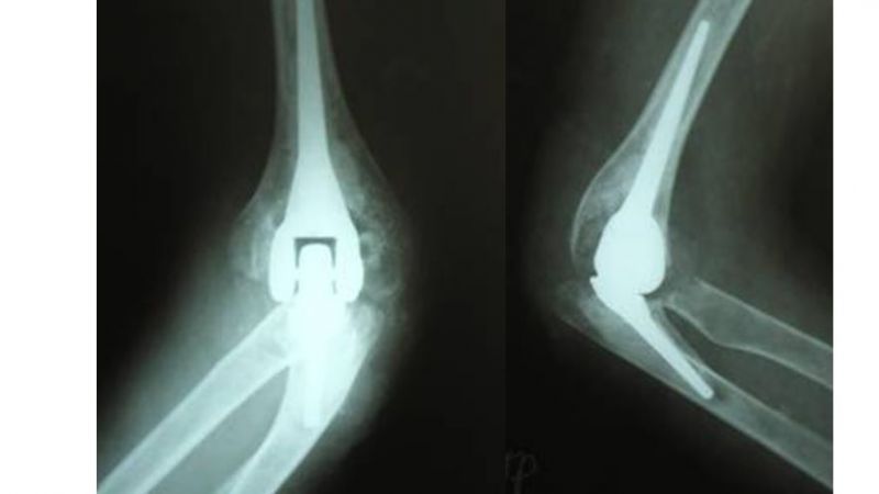 Rehabilitation after Elbow joint replacement