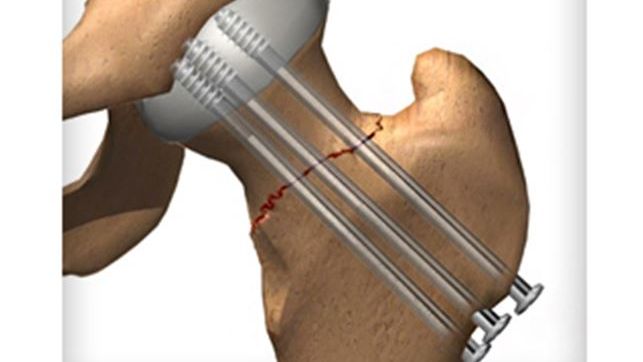 Osteosynthesis of juxtaarticular and intraarticular fractures