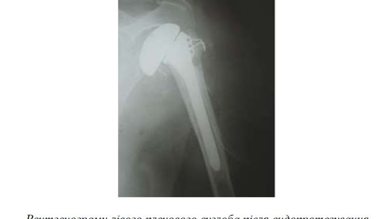 Rehabilitation after Humeral joint replacement