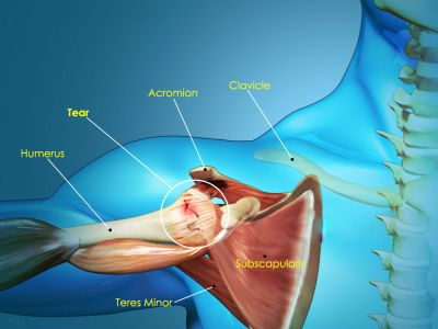 The Analysis of Surgical Treatment Results in Rotator Cuff Tears