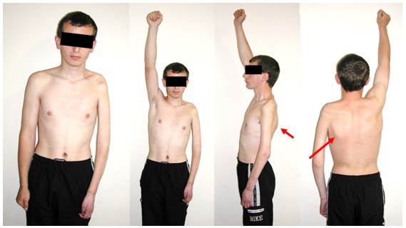Пацієнт з тотальною авульсією корінців плечового сплетення зліва. Стрілкою показано «криловидну лопатку» що виникає при ураженні довгого грудного нерва