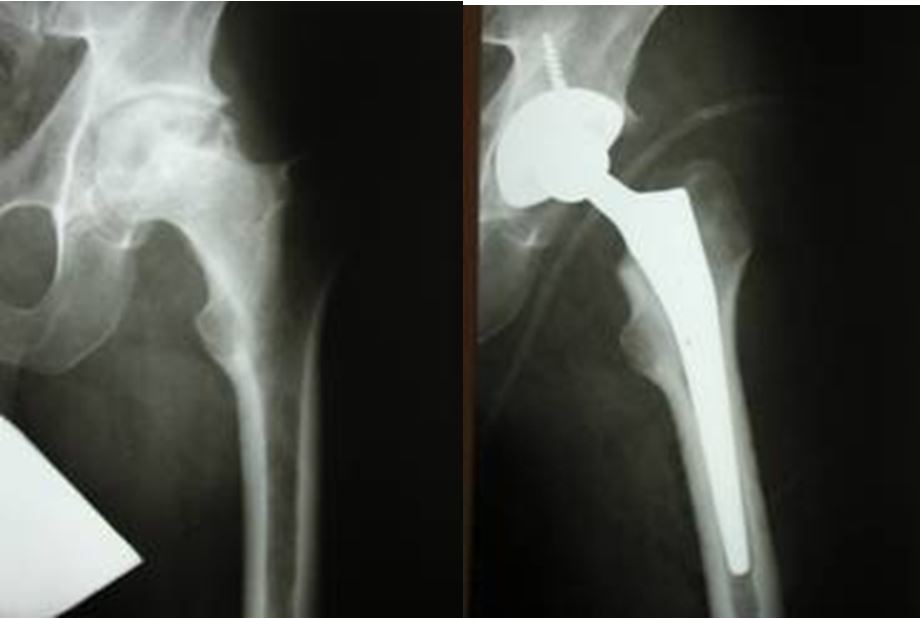 Hip replacement clinic №3, Kyiv, Ukraine, ITO NAMS of Ukraine