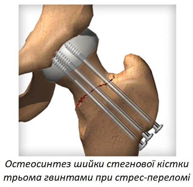 Osteosynthesis of juxtaarticular and intraarticular fractures in the ...