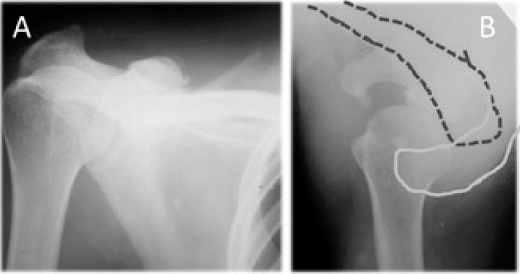 Fig. 1 A – Zanca view x-ray of the AC joint: Rockwood type VI dislocation, B – axillary view x-ray of AC joint: Rockwood type IV