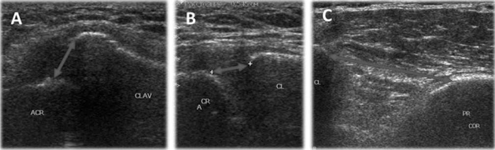 Fig. 2. Ultrasonographic examination of the AC joint: A – distance between the upper border of acromion and clavicle, vertical displacement of the acromial end of the clavicle in the frontal view, B – distance between the anterior border of acromion and clavicle, horizontal instability in axial view, C – distance between the upper border of the coracoid and lower border of clavicle, vertical instability