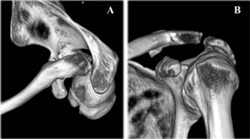Fig. 4. CT of the shoulder joint (A - Rockwood type IV AC joint dislocation in the axial plane, B – AC joint dislocation is not detected in the coronal plane)