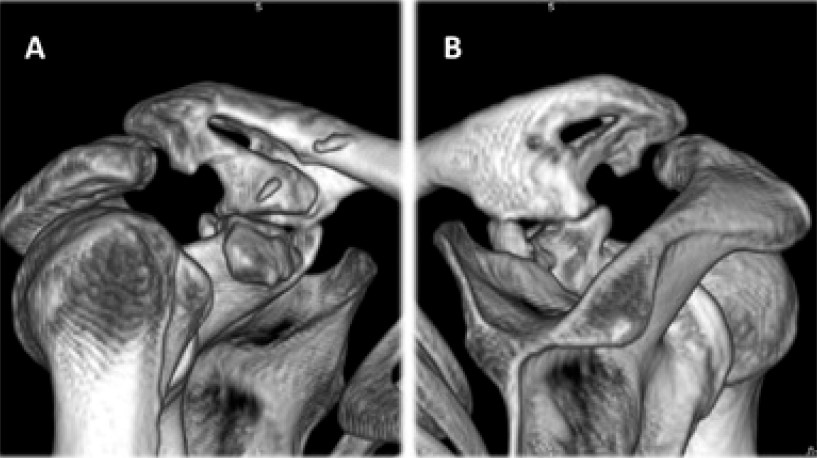 Fig. 6. Ossification of coracoclavicular and coracoacromial ligaments (A – frontal view, B – posterior view)