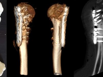 Коррекционная остеотомия неправильноконсолидированного перелома плечевой кости