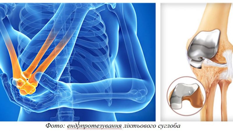 Эндопротезирование локтевого сустава