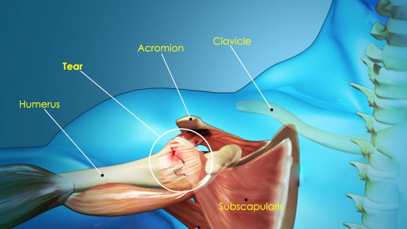 Анализ результатов оперативного лечения повреждений ротаторной манжеты плеча
