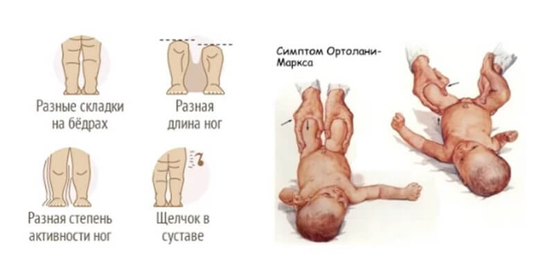 Реферат: Дисплазия тазобедренных суставов новорожденных